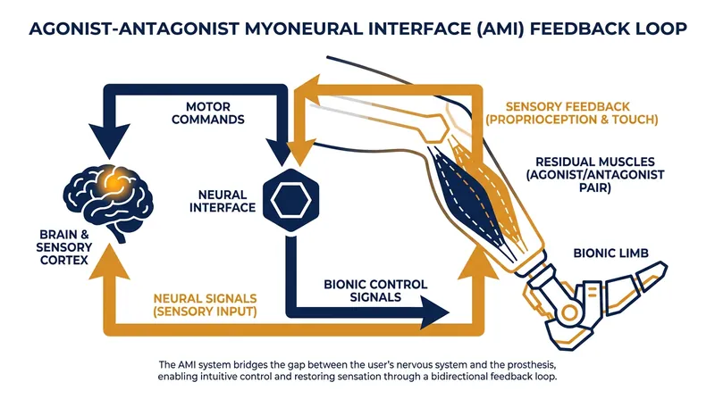 The AMI surgical technique preserves the natural sensory feedback loop, allowing the brain to feel the bionic limb.
