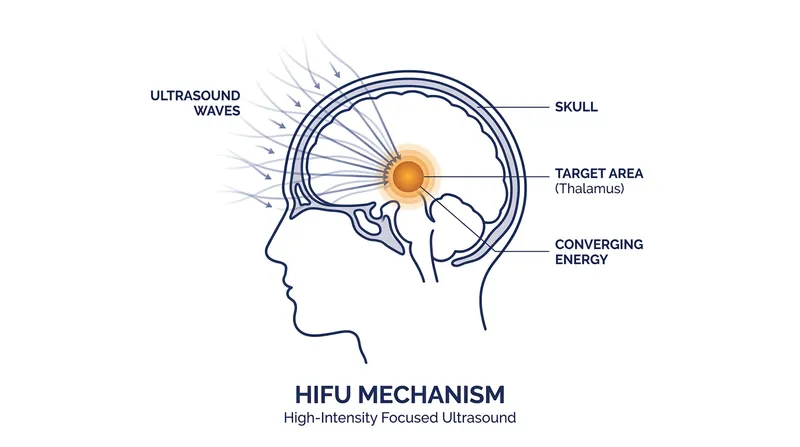 Ultrasound waves pass harmlessly through the skull, generating intense heat only at the precise point where the beams intersect.