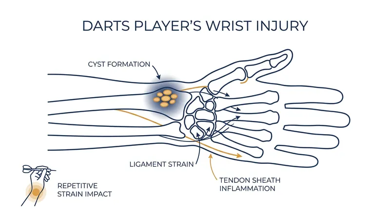 A torn ligament from a heavy lifting accident caused a cyst that pressed against Van den Bergh's nerves.
