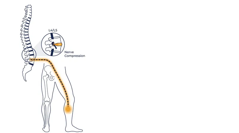 A ruptured spinal disc can severely disrupt nerve signals to the lower leg, making explosive movements like figure skating jumps impossible.