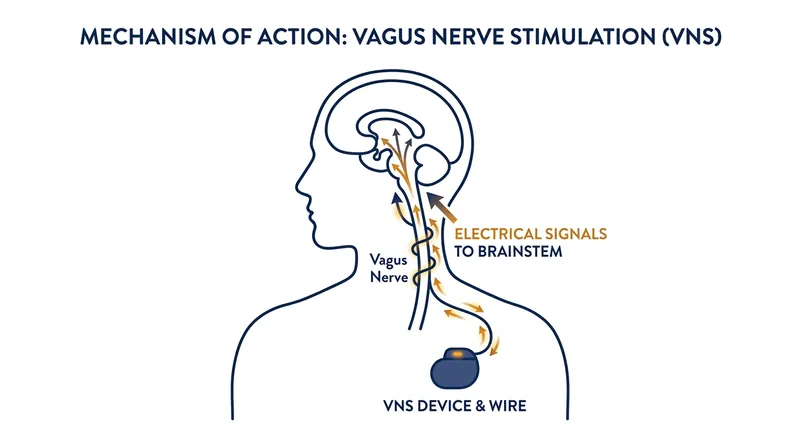 The implanted device sends continuous electrical pulses up the vagus nerve, modulating mood centers in the brain from the 'bottom up.'