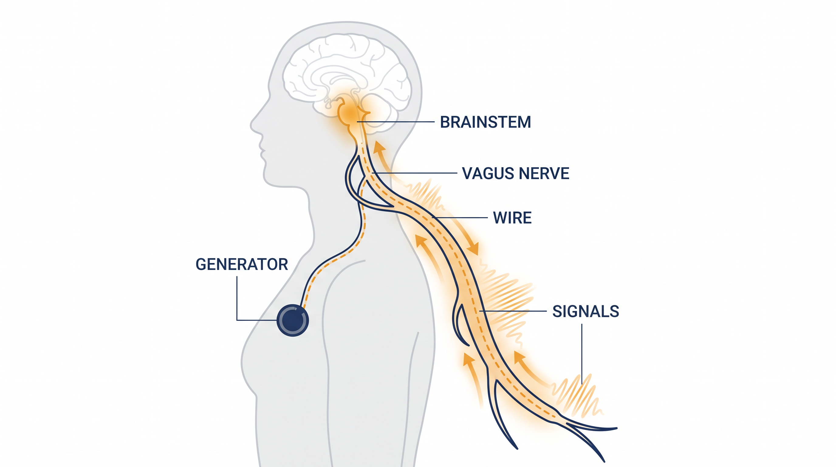 How it works: The device acts as a pacemaker for the brain, delivering mild electrical pulses to mood-regulating centers.