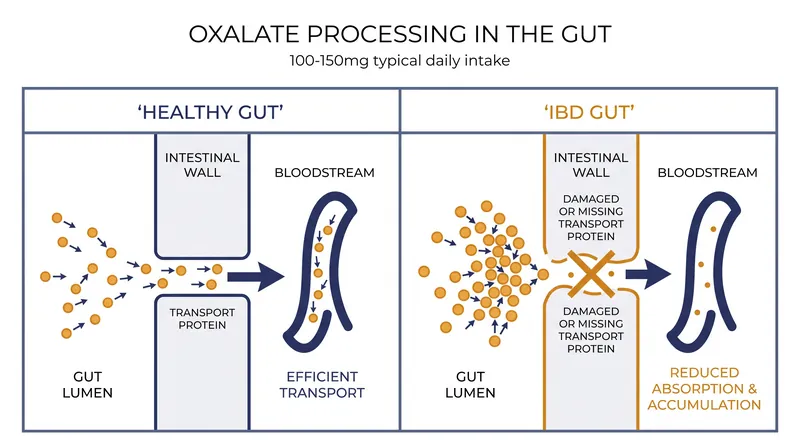 How the loss of specialized transporters causes oxalates to pool in an inflamed gut.