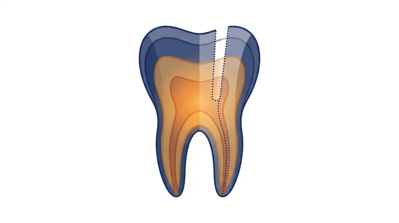 By drilling through the hard dentin into the pulp chamber, the pressure from the infection could be released.