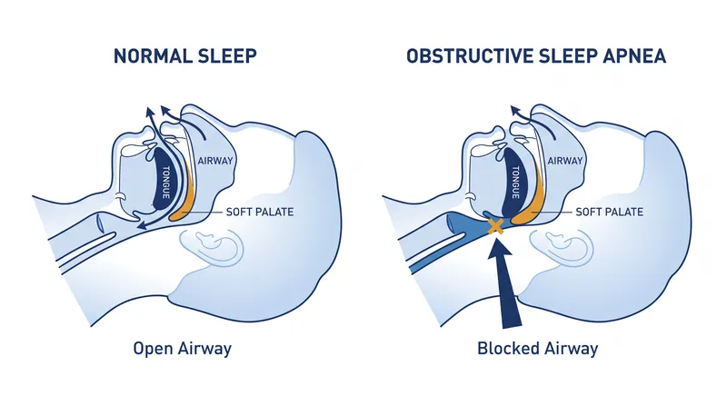 Obstructive sleep apnea occurs when the muscles in the back of the throat relax, allowing the airway to collapse during sleep.