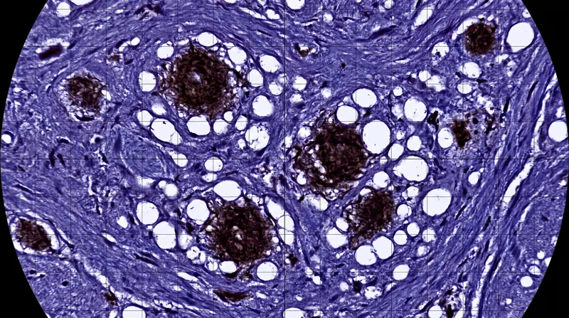 The accumulation of indestructible beta-sheet aggregates leads to widespread neuronal death and the characteristic sponge-like appearance of the brain.