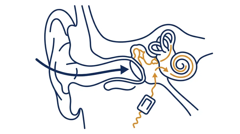 By vibrating the temporal bone, the technology bypasses the tympanic membrane and ossicles entirely.