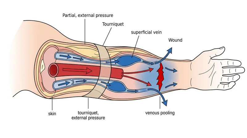A partially loosened tourniquet traps venous blood in the limb while allowing arterial blood to enter, accelerating hemorrhage.