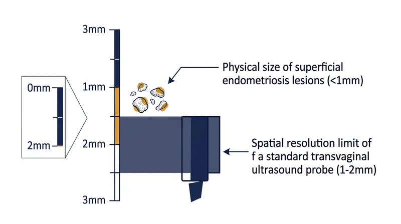 Superficial peritoneal implants are physically smaller than the spatial resolution limits of standard clinical ultrasound machines.