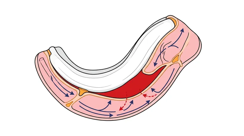 A subperichondrial hematoma creates a physical barrier that starves the avascular cartilage of oxygen.