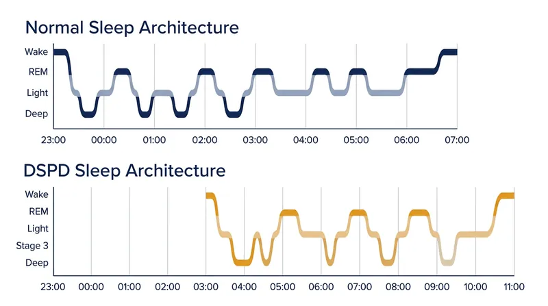 When allowed to sleep on their delayed schedule, patients with DSPD generate perfectly normal sleep architecture.