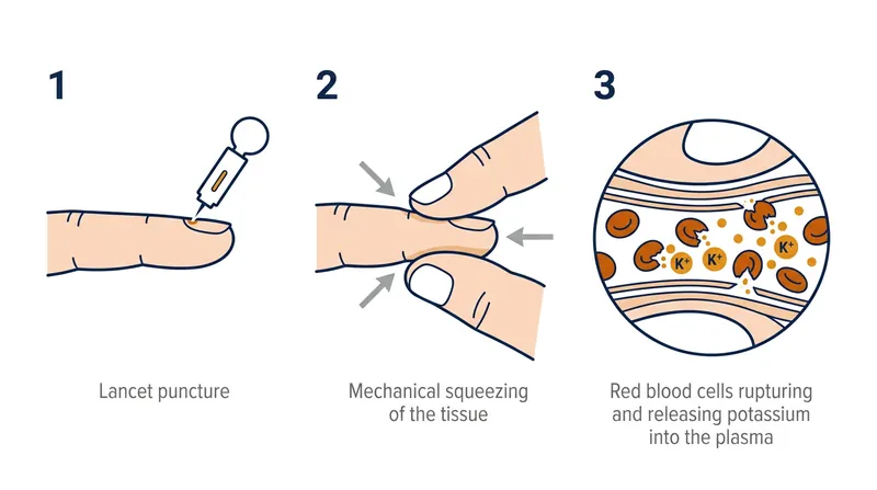 The mechanical force used to extract capillary blood physically tears red blood cell membranes, contaminating the plasma.